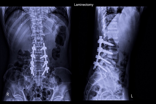 脊柱分離症は高齢者だけでなく激しい運動をしている若年層にも発生していることがあります